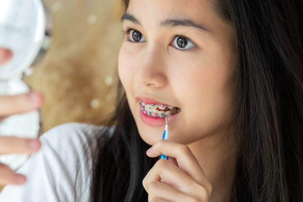 Things You Should Know Before Getting Braces In Kepong