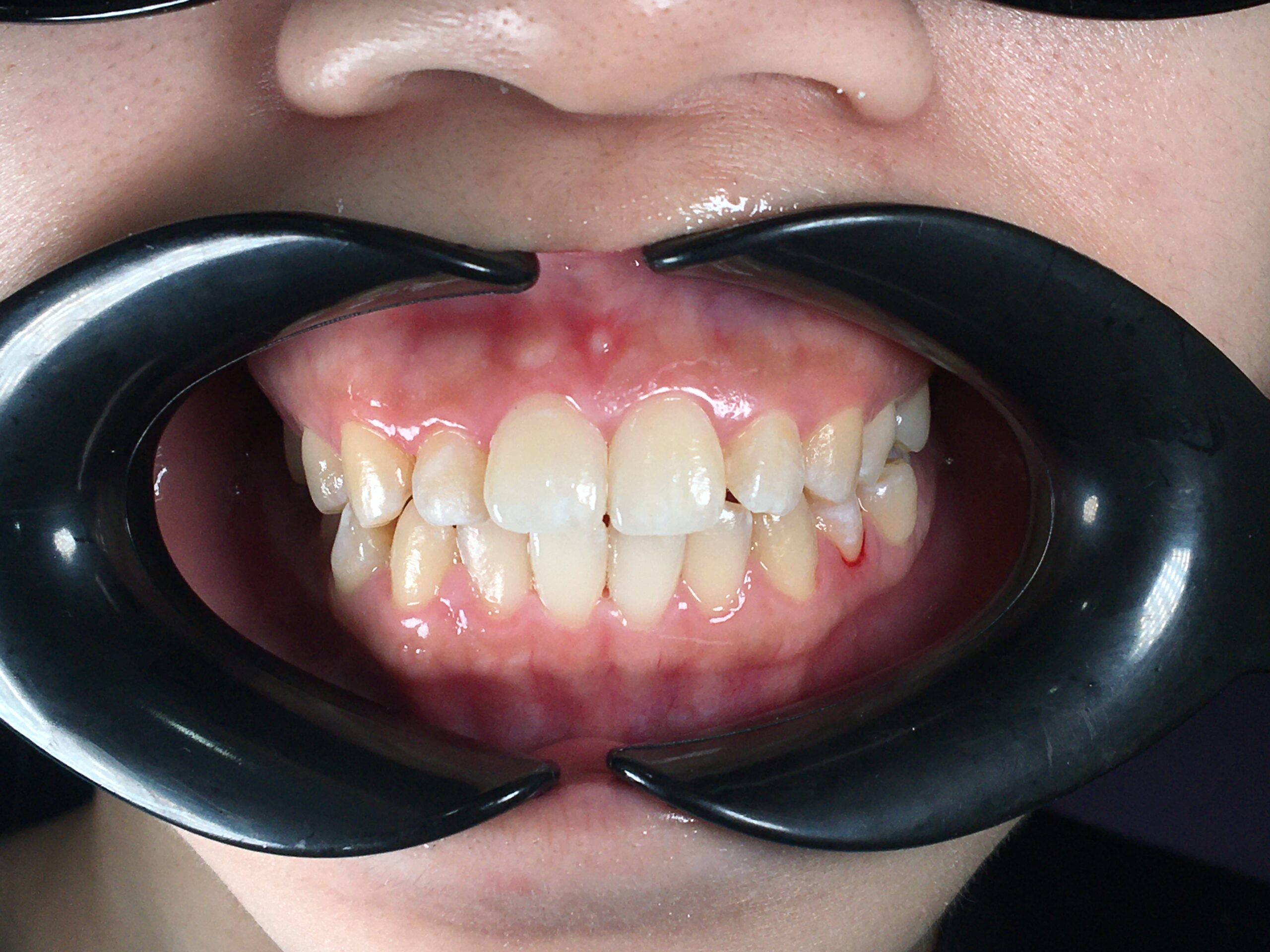 Scaling & Polishing 6 protrusive teeth before scaled