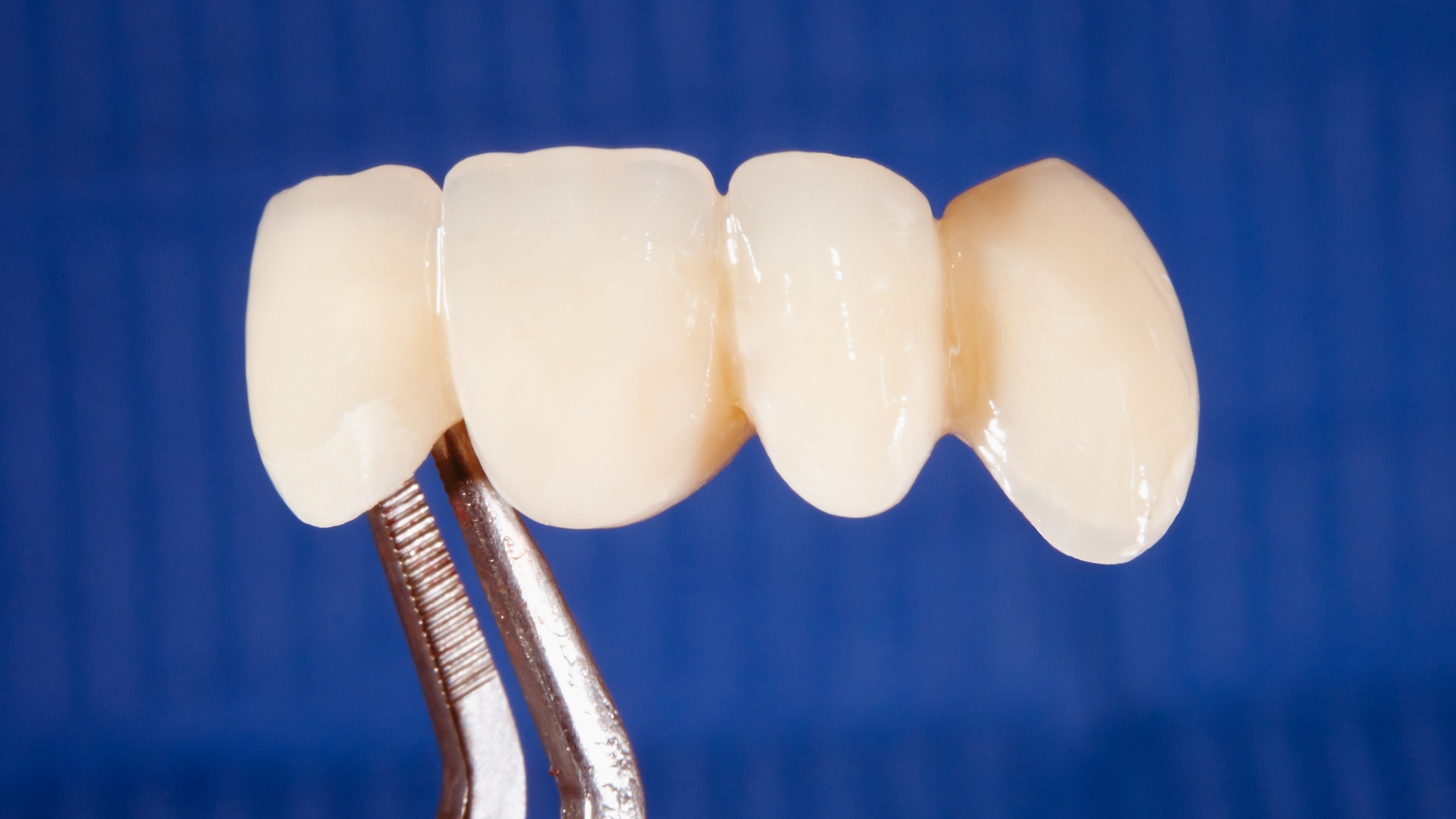 Crown and Bridge 6 Crowns Bridges treatment in kepong