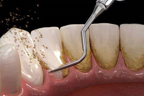 Scaling & Polishing 2 Teeth Scaling and Polishing Clinic in Kepong, KL