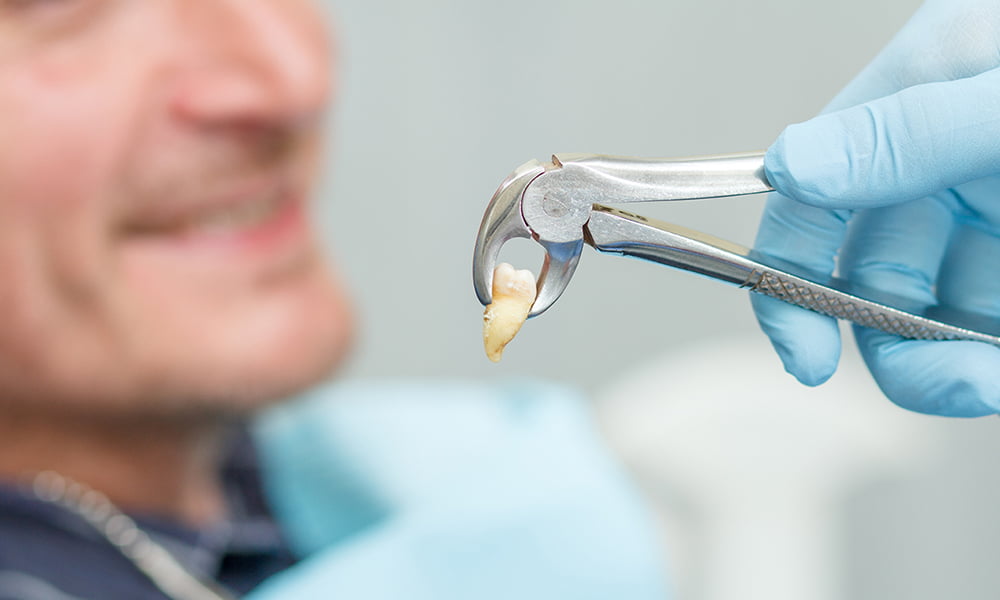 Tooth Extraction 6 Tooth Extraction in Kepong, KL
