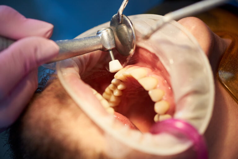 Teeth Scaling vs Cleaning: What's the Difference? 1 Teeth Scaling in Kepong, KL