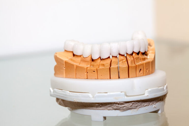 Dental Restoration With Dental Crowns 1 Porcelain Fused to Metal vs. Zirconia Crown in Malaysia