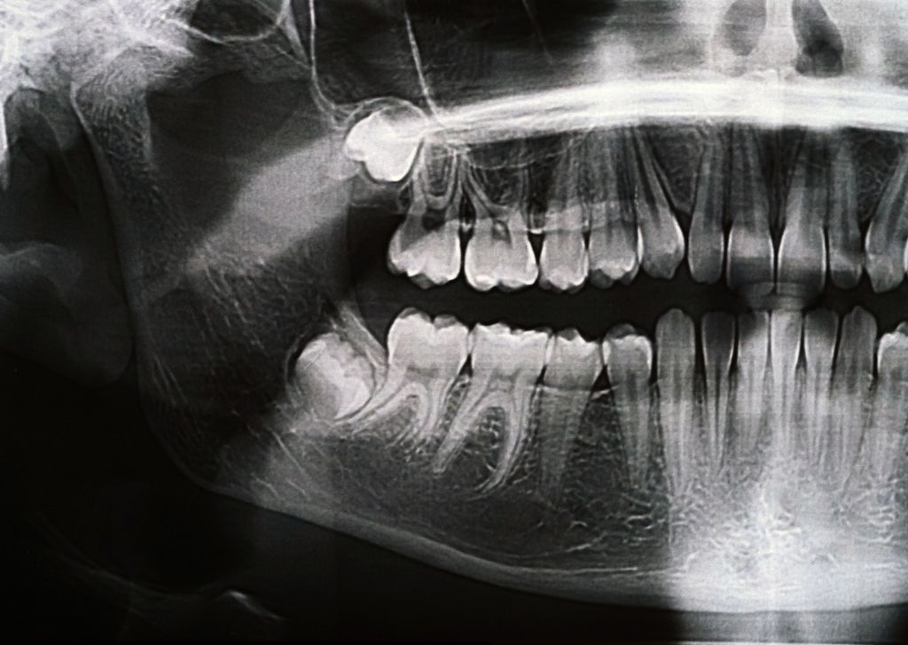 What Is an Impacted Wisdom Tooth & What Happens If You Don't Extract It? 7 What Is an Impacted Wisdom Tooth & Why You Shouldn’t Ignore It