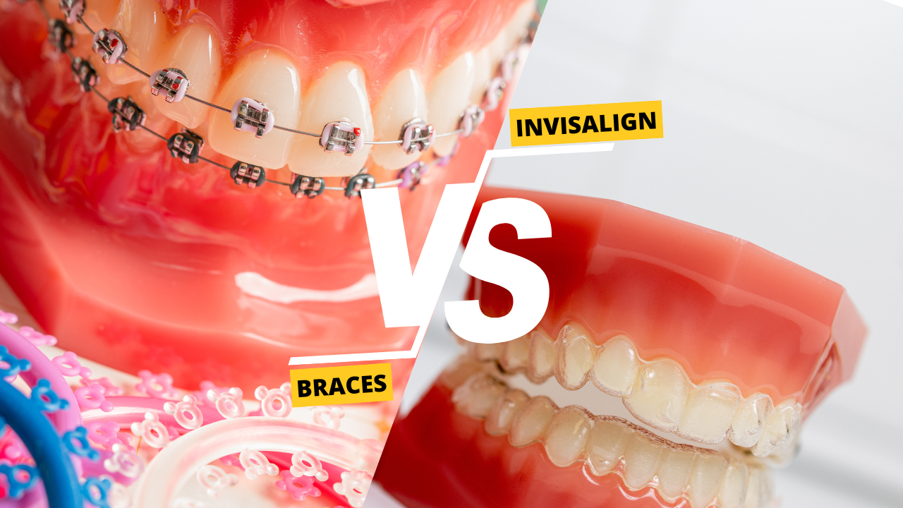 Invisalign vs. Braces: Which is the Better Option for Malaysians? 1 illustration of Invisalign vs braces cost & benefit guide at fresh dental kepong