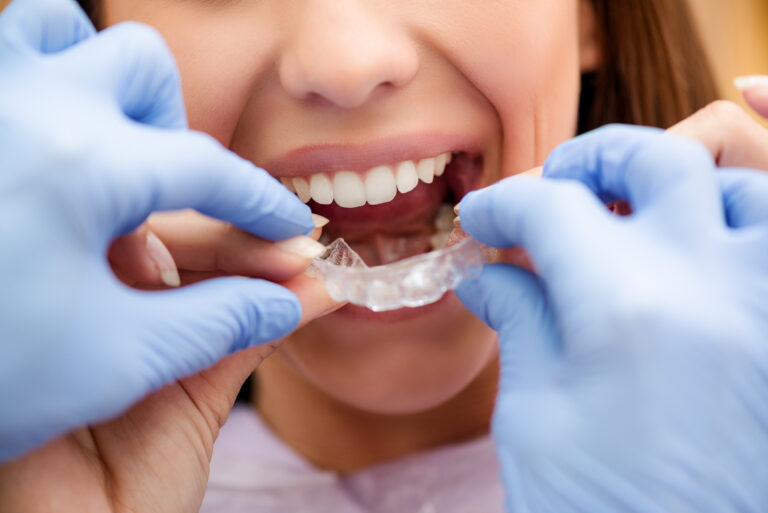 Invisalign vs. Braces: Which is the Better Option for Malaysians? 5 benefits of Invisalign & braces fresh dental kepong