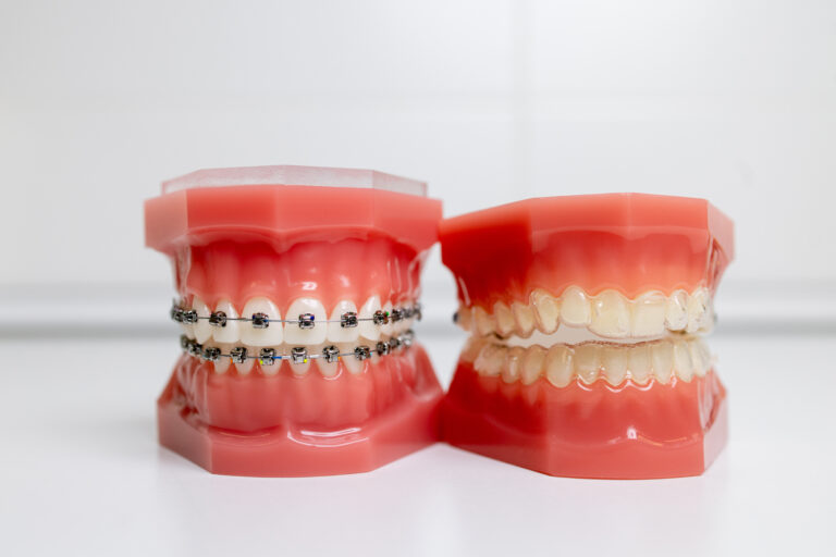 Invisalign vs. Braces: Which is the Better Option for Malaysians? 6 comparison of Invisalign and braces for overbite fresh dental kepong