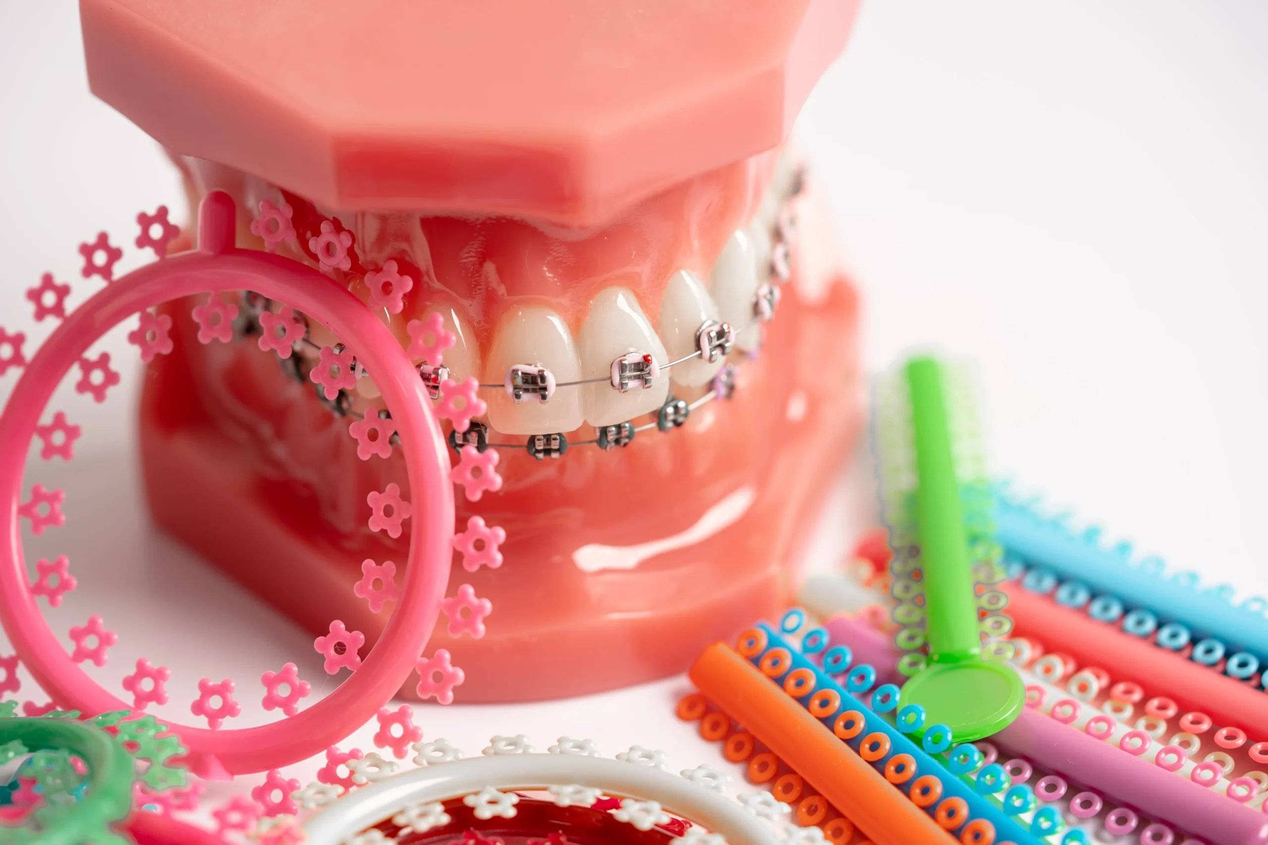 self ligating braces colors