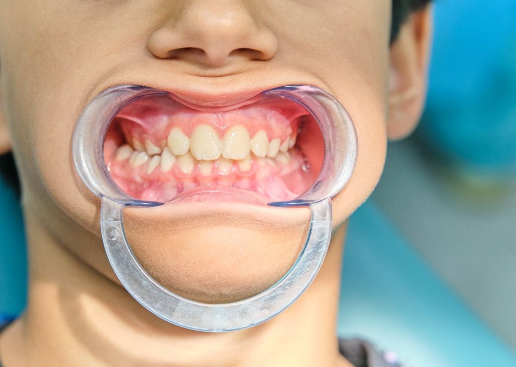 Why You Might Need Soft Tissue or Bone Grafting – Fresh Dental Kepong