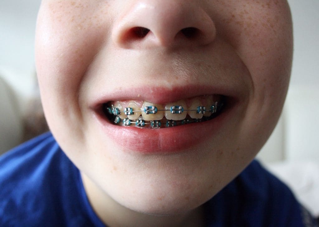 Braces for Kids in Malaysia - Costs, Types & When to Start 2 Child showing braces done to their teeth at a dentist in Kepong.