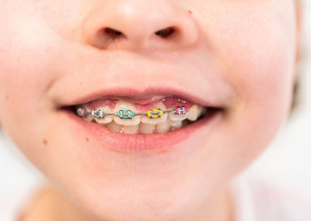 Braces for Kids in Malaysia - Costs, Types & When to Start 2 Child showing colored braces on their teeth