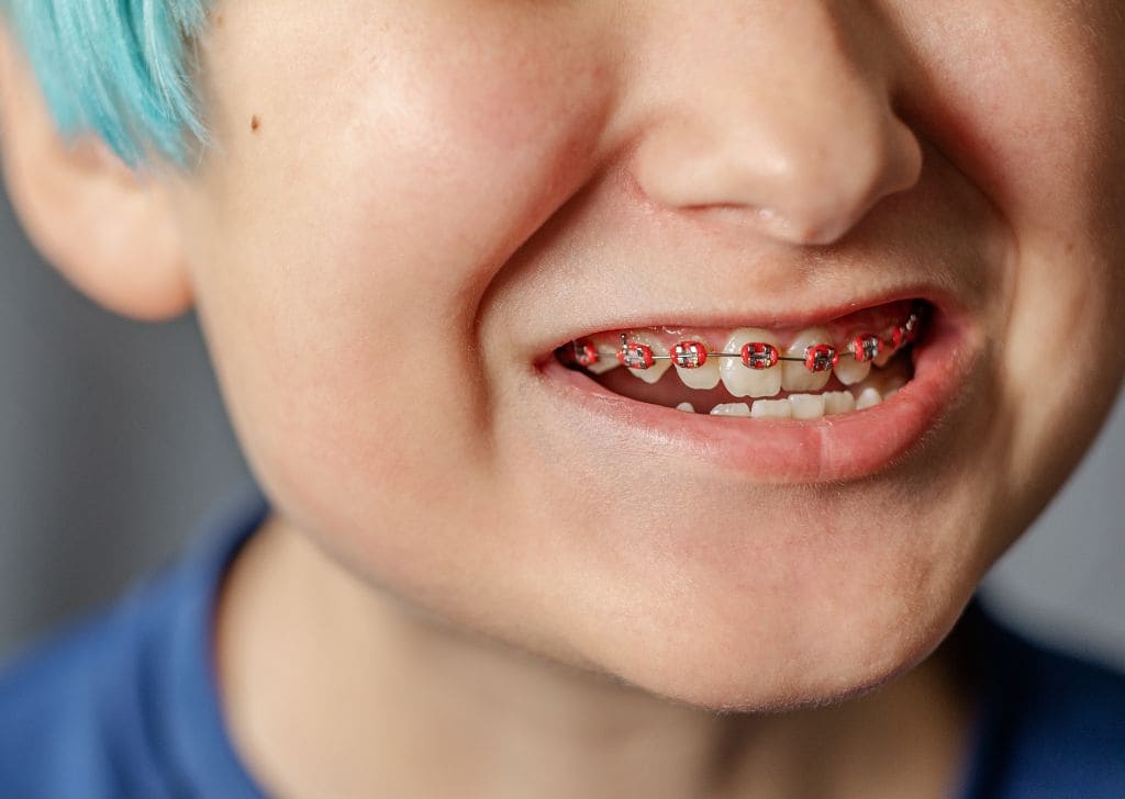 Braces for Kids in Malaysia - Costs, Types & When to Start 4 A child showing the braces on their teeth after getting it done at a dentist in Kepong.