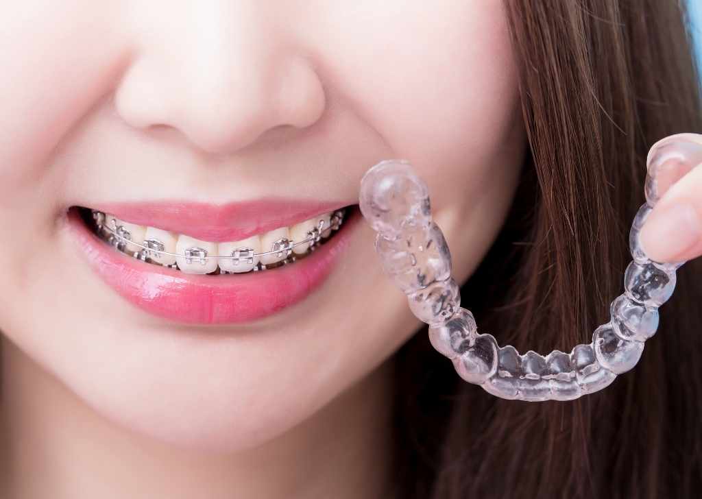 Braces vs Aligners: Which Is the Best Way to Fix Crooked Teeth? 2 Wondering how to fix crooked teeth? Let’s break down the pros and cons of braces vs aligners, timelines, and options at Fresh Dental Kepong.