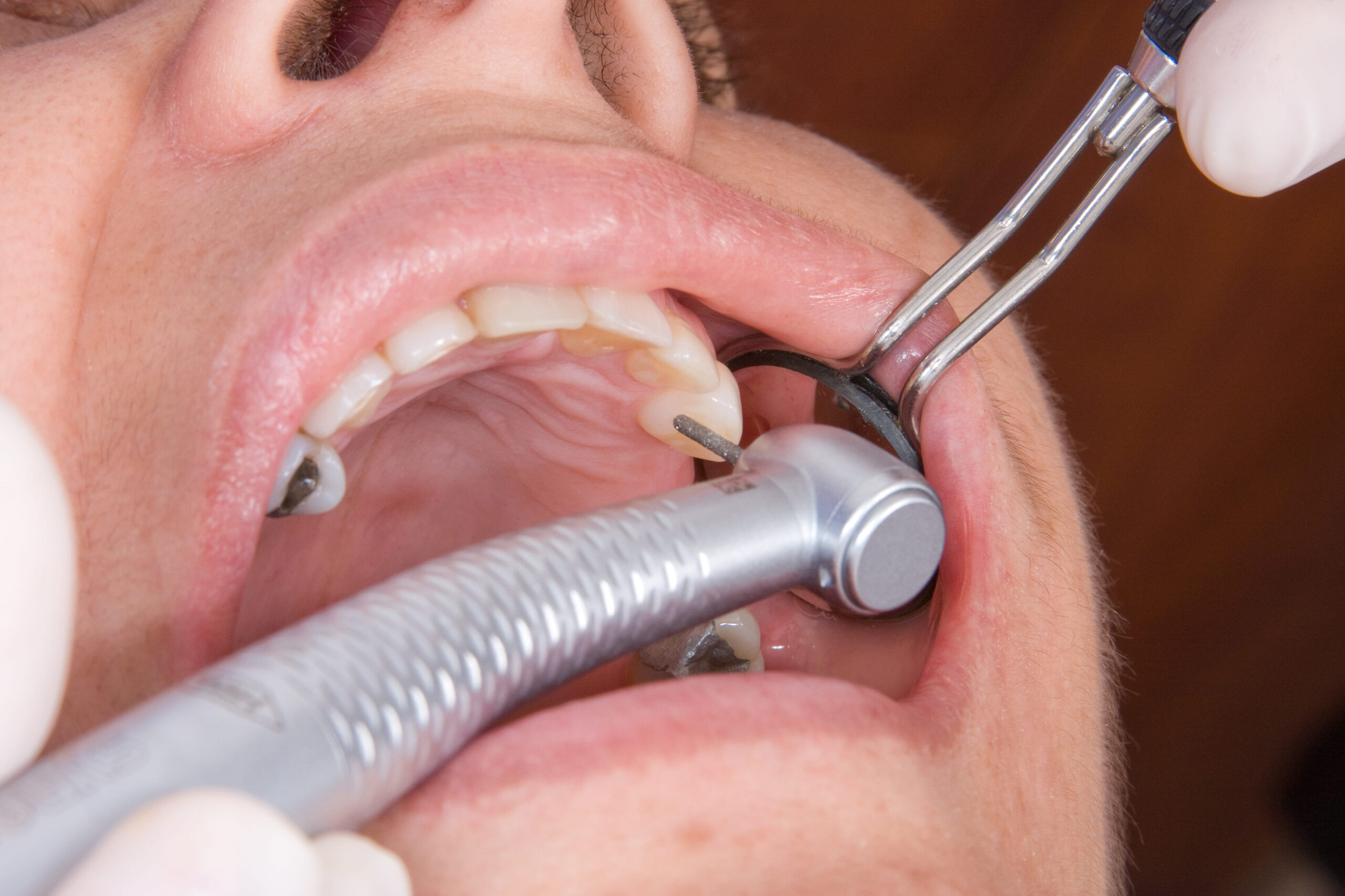How Often Do Dental Fillings Need To Be Replaced? 4 Discover the five common warning signs that your dental filling is wearing out.
