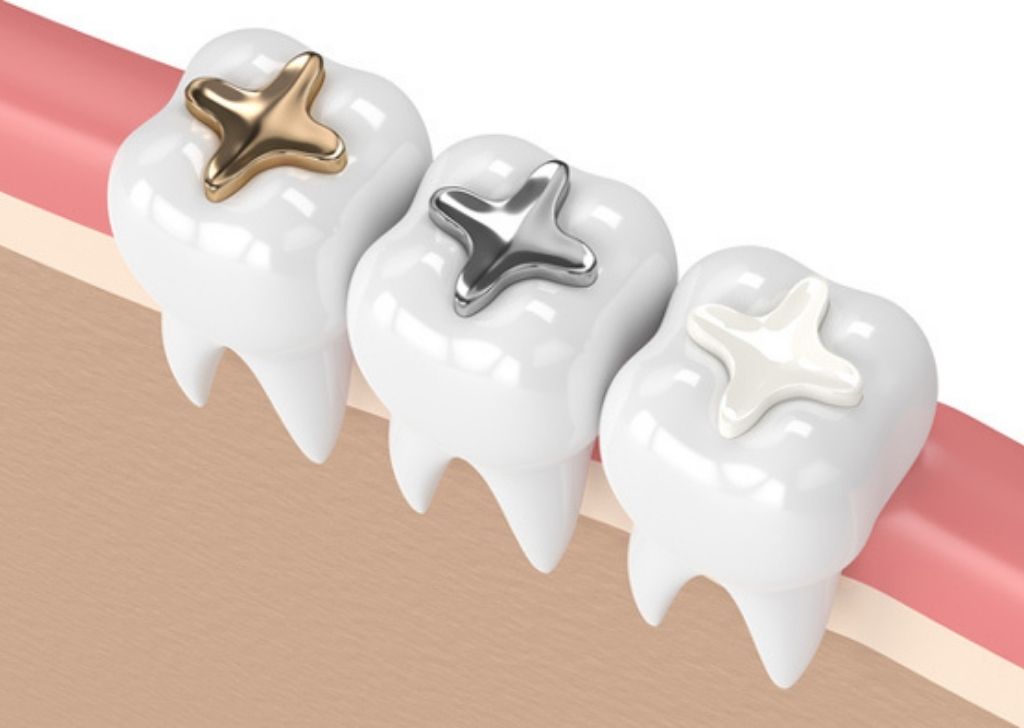 How Often Do Dental Fillings Need To Be Replaced? 2 Their lifespan depends on the filling material, the location of the filling, and your oral care habits