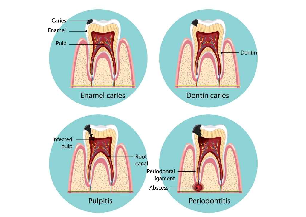 What Causes Tooth Decay and When Do You Need To Get It Out? 3 Learn about the 4 stages of tooth decay. The sooner you know, the easier (and less expensive) it is to manage.