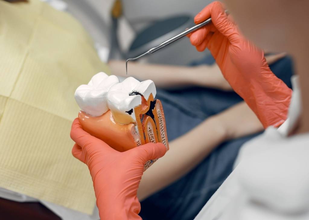 What Causes Tooth Decay and When Do You Need To Get It Out? 5 Find out about the types of treatment depends on how far the decay has progressed.