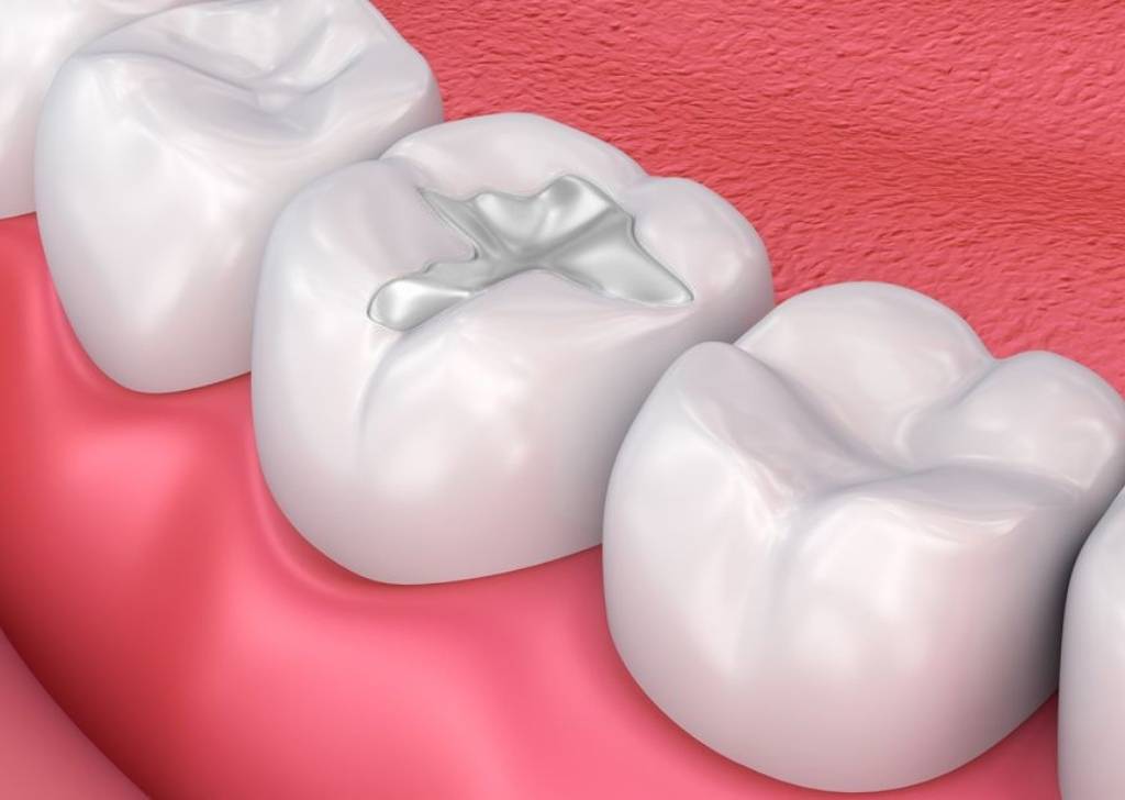 Dental Composite or Amalgam? Here’s Why More People Choose Composite 1 Discover how long composite dental fillings last, when to replace them, and how dentist services at Fresh Dental Care Kepong ensure durability.