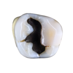 Dental Composite or Amalgam? Here’s Why More People Choose Composite 3 amalgam filling