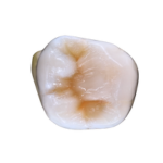 Dental Composite or Amalgam? Here’s Why More People Choose Composite 2 composite filling