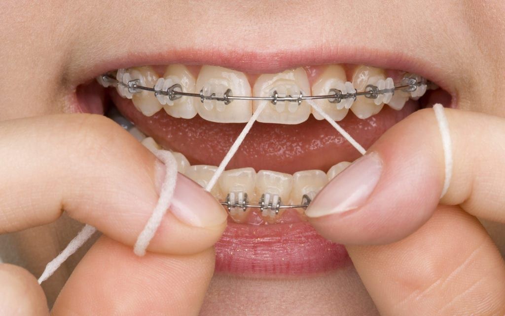 Brace Yourself: Foods to Avoid With Braces and Why 4 flossing with braces