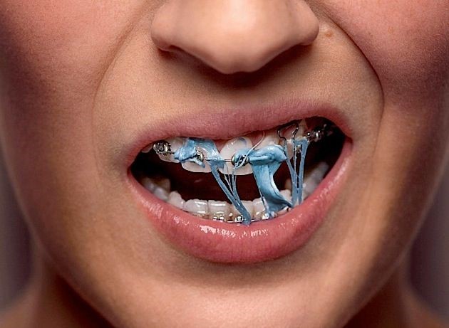 Brace Yourself: Foods to Avoid With Braces and Why 2 braces eating candy