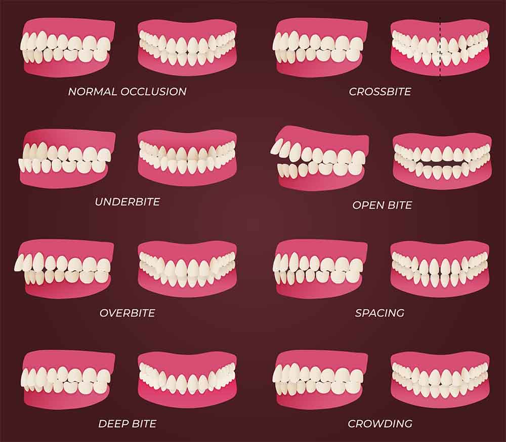When Is the Best Time to Get Braces? 2 best time to get braces