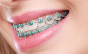 Jenis Gigi Yang Boleh Pakai Braces: Adakah Anda Sesuai? 7 rubber bands for braces scaled 1