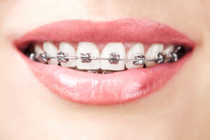 1484599716pros and cons of different types of braces