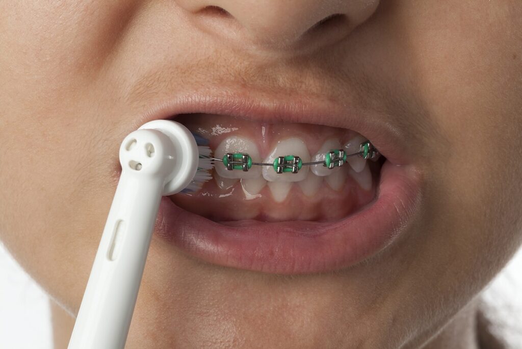 braces electric toothbrush