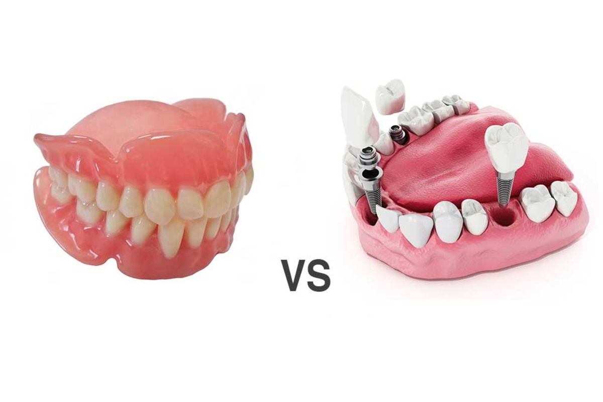 denture vs implant