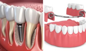 denture vs implant