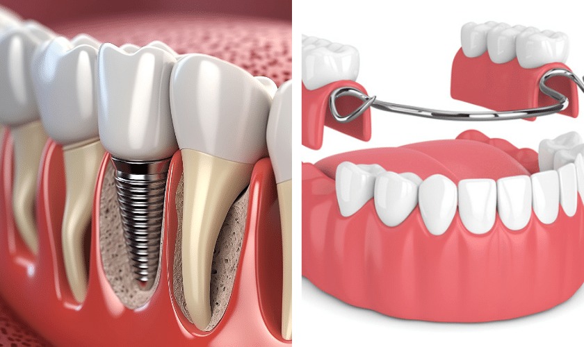 denture vs implant