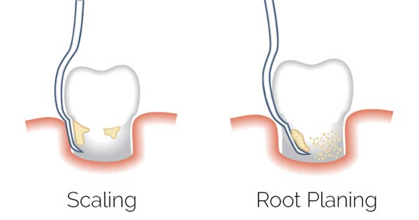 Does Scaling and Polishing Hurt? Here’s what to expect 3 Regular Scaling Vs Deep Scaling or Root Planing