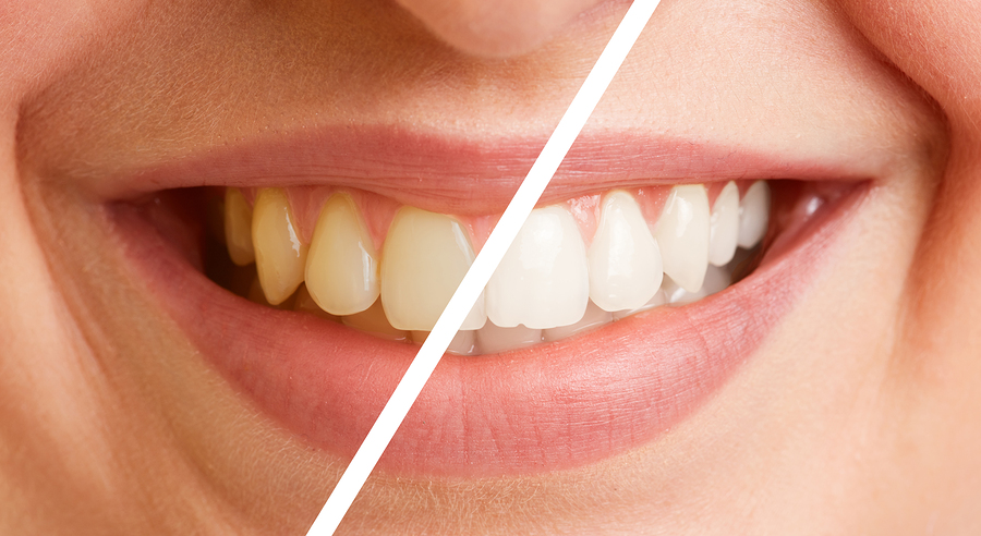 scaling and polishing vs teeth whitening