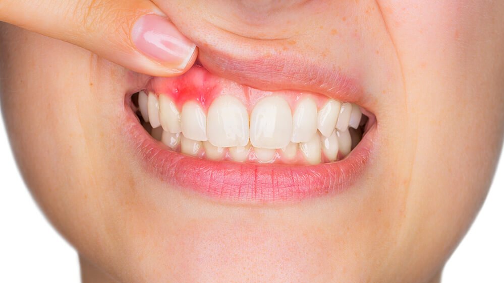 Does Scaling and Polishing Hurt? Here’s what to expect 2 gums inflamed