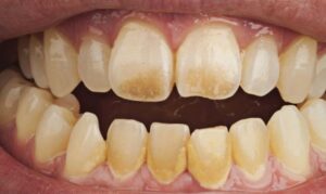 why some foods and drinks stain teeth more than others