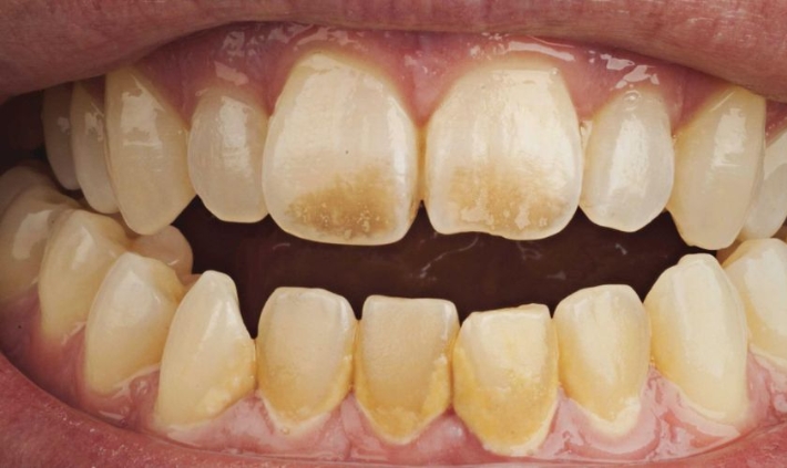 why some foods and drinks stain teeth more than others