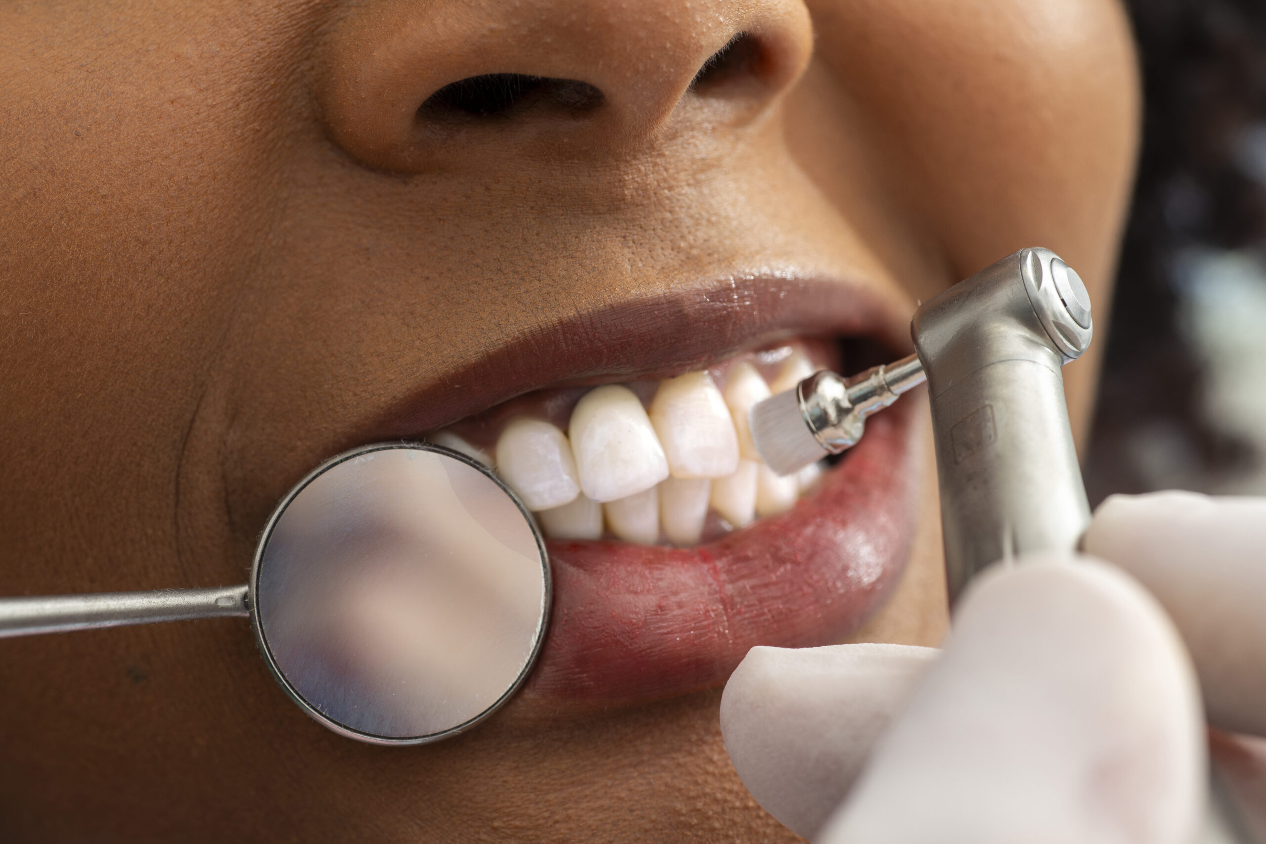 dentist polishing teeth of patient in dental clinic scaled