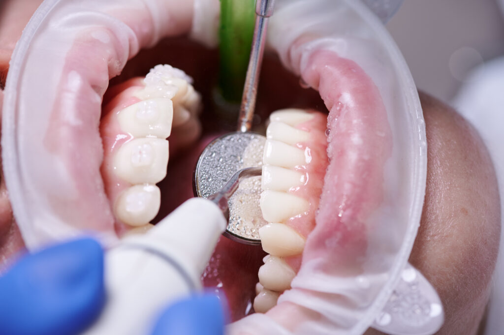 Teeth Cleaning vs Scaling - Which Is the Better Option for Cleaner Teeth in Kepong? 1 Scaling and Polishing