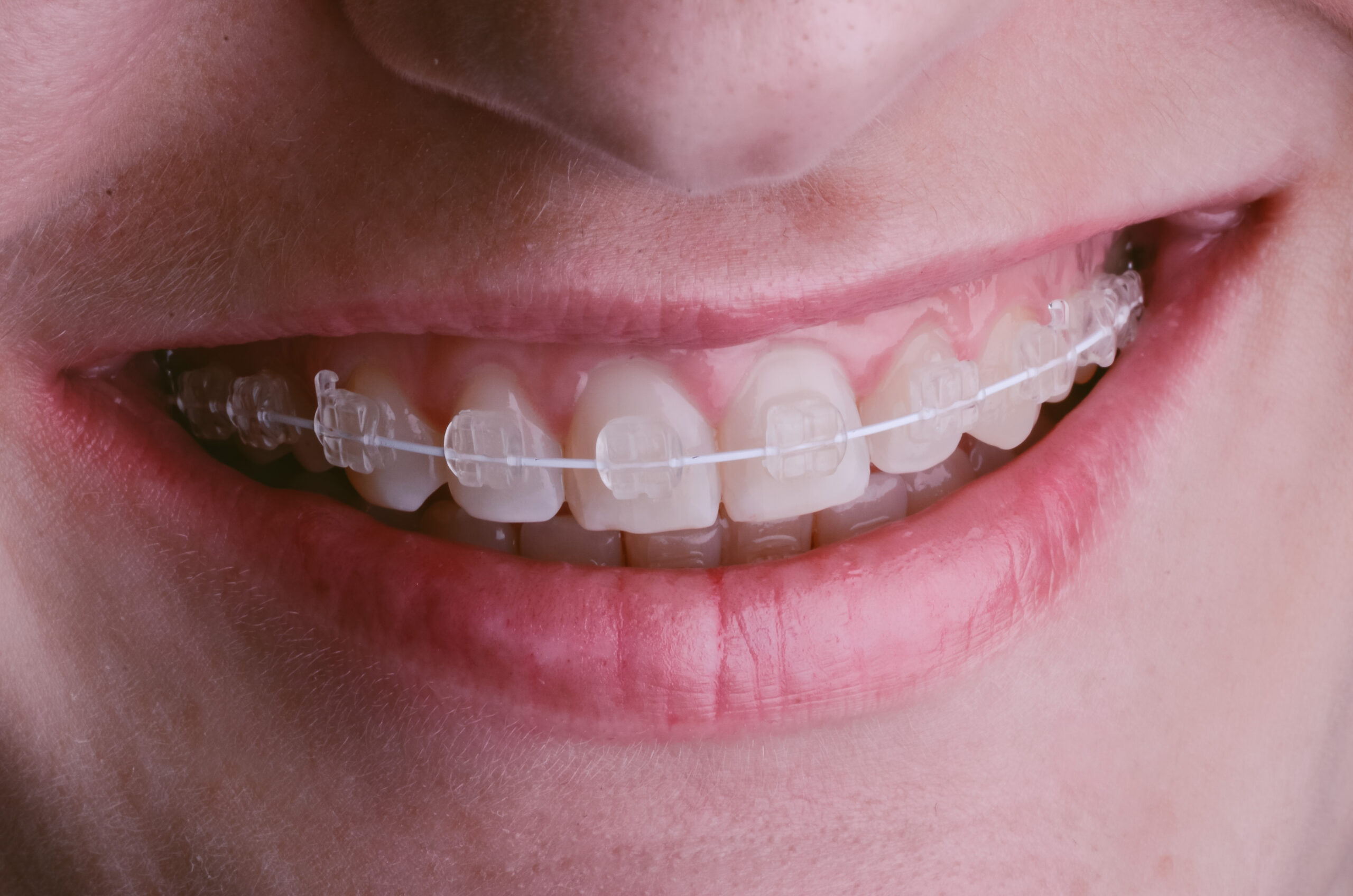 braces dental treatment