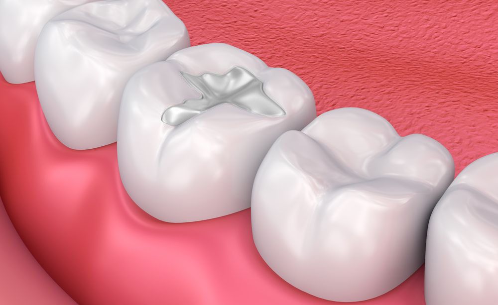 tooth filling