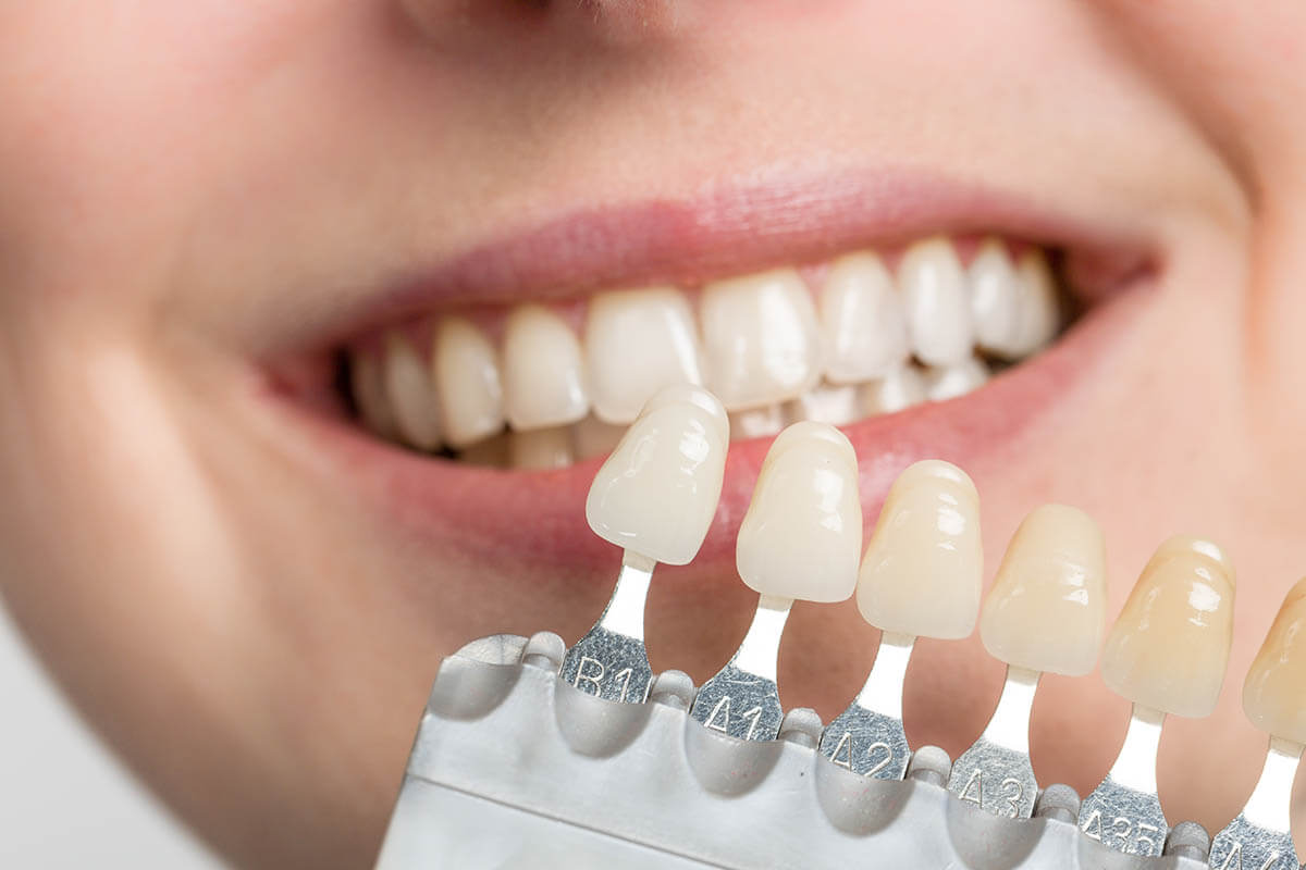 veneers
