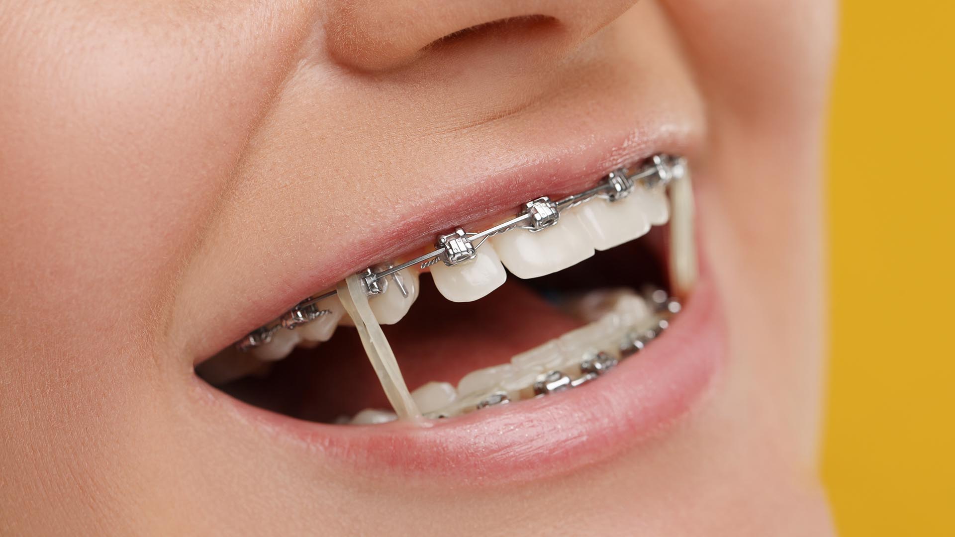 braces treatment