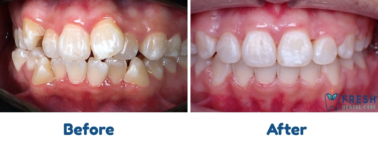 braces treatment