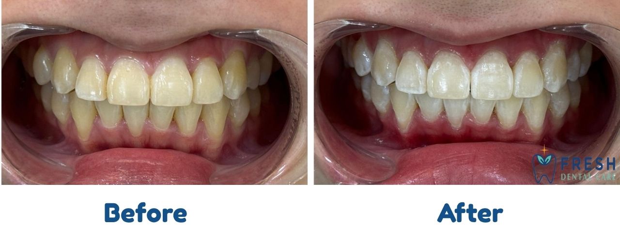 teeth whitening