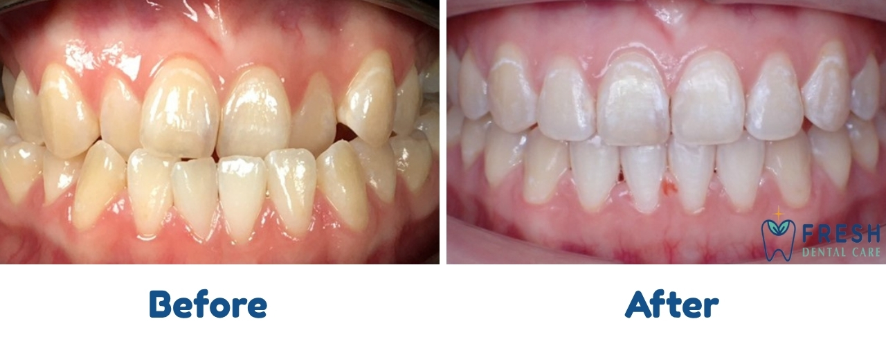 braces treatment
