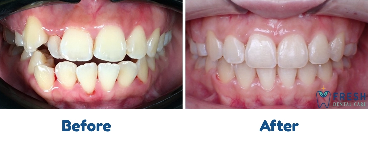 braces treatment