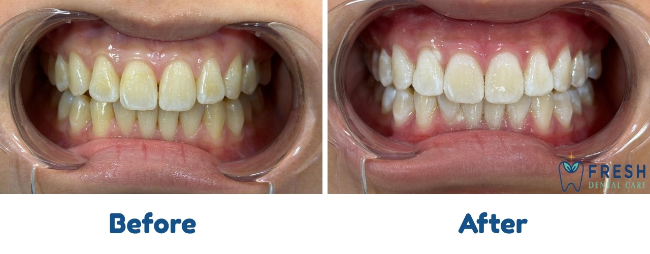 teeth whitening