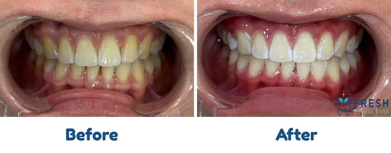 teeth whitening
